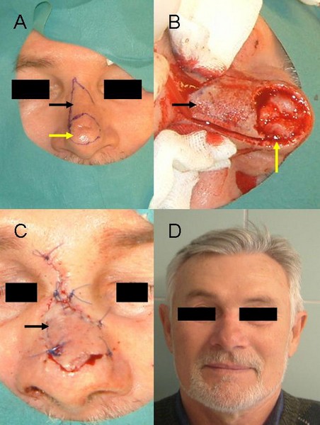 1. ábra: Orrcsúcsi elhelyezkedésű tumor eltávolítása és a bőrhiány pótlása orrháti lebennyel.