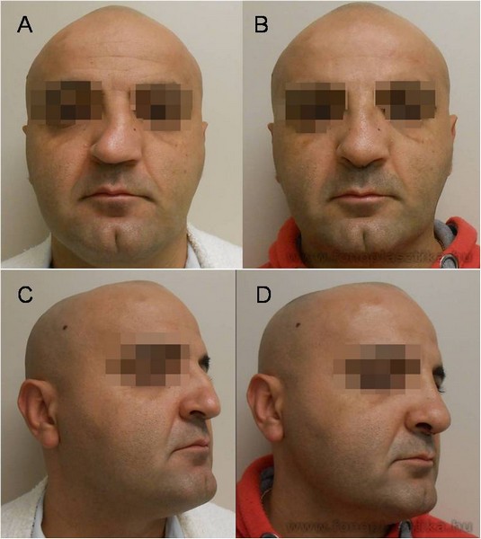 4. ábra. Deviatio nasi képei műtét előtt (4/A,C) és műtét után (4/B,D).