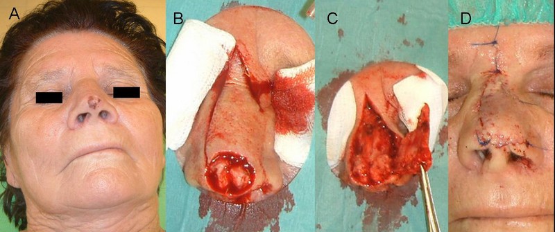 2. ábra: Orrcsúcsi elhelyezkedésű, a columella felé terjedő tumor eltávolítása és a bőrhiány pótlása orrháti lebennyel.