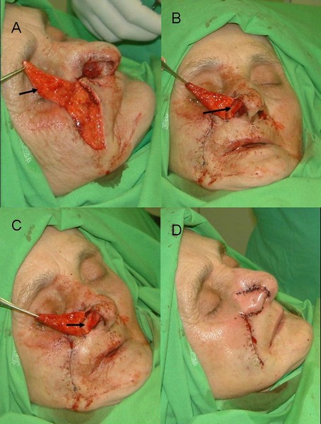 5. ábra: Nasolabialis lebeny és porcgraft felhasználásával végzett műtét menete.