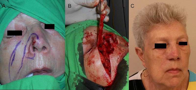 6. ábra: Orrszárnyat, orrcsúcsot infiltráló, az orrszárny szabad szélét is destruáló tumor eltávolítása és rekonstrukciója.