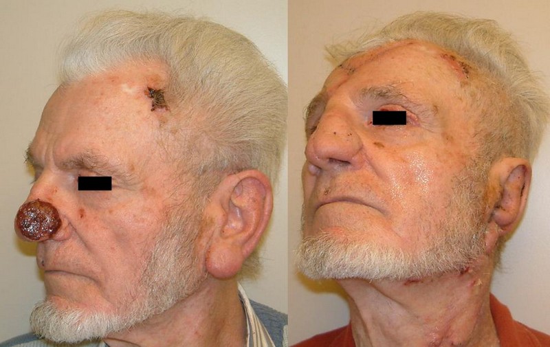 9. ábra: Orrcsúcsot és bal oldali orrszárnyat infiltráló tumor eltávolítás utáni rekonstrukció homloklebeny és orrsövényporc segítségével.
