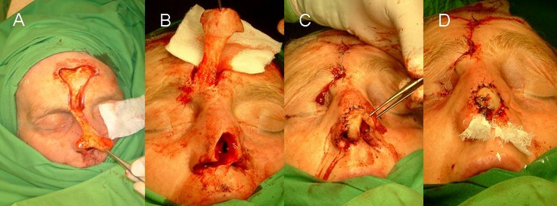 10. ábra: Orrcsúcsot, columellát és mindkét oldali orrszárnyat infiltráló recidiv tumor eltávolítás utáni rekonstrukció lépései homloklebeny és orrsövényporc segítségével.