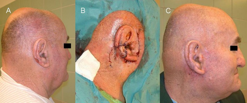 12. ábra: A fülkagyló ívét, elülső és hátsó felszínét is infiltráló tumor eltávolítása és a fülkagyló rekonstrukciója.