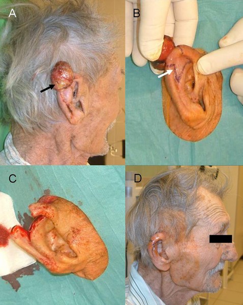 13. ábra: A fülkagyló ívének felső harmadát infiltráló tumor eltávolítása és a fülkagyló rekonstrukciója.
