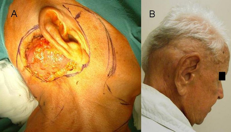 14. ábra: Retroauricularis kiindulású, a fülkagyló hátsó felszínét infiltráló laphámkarcinóma eltávolítása, a fülkagyló és a retroauricularis területe rekonstrukciója prea- és retroauricularis lebenyek felhasználásával.