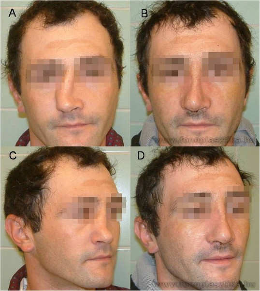 5. ábra. Deviatio nasi képei műtét előtt (5/A,C) és műtét után (5/B,D).