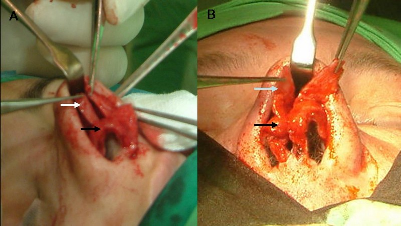 10. ábra. Összetett orrháti deformitás korrekciója.